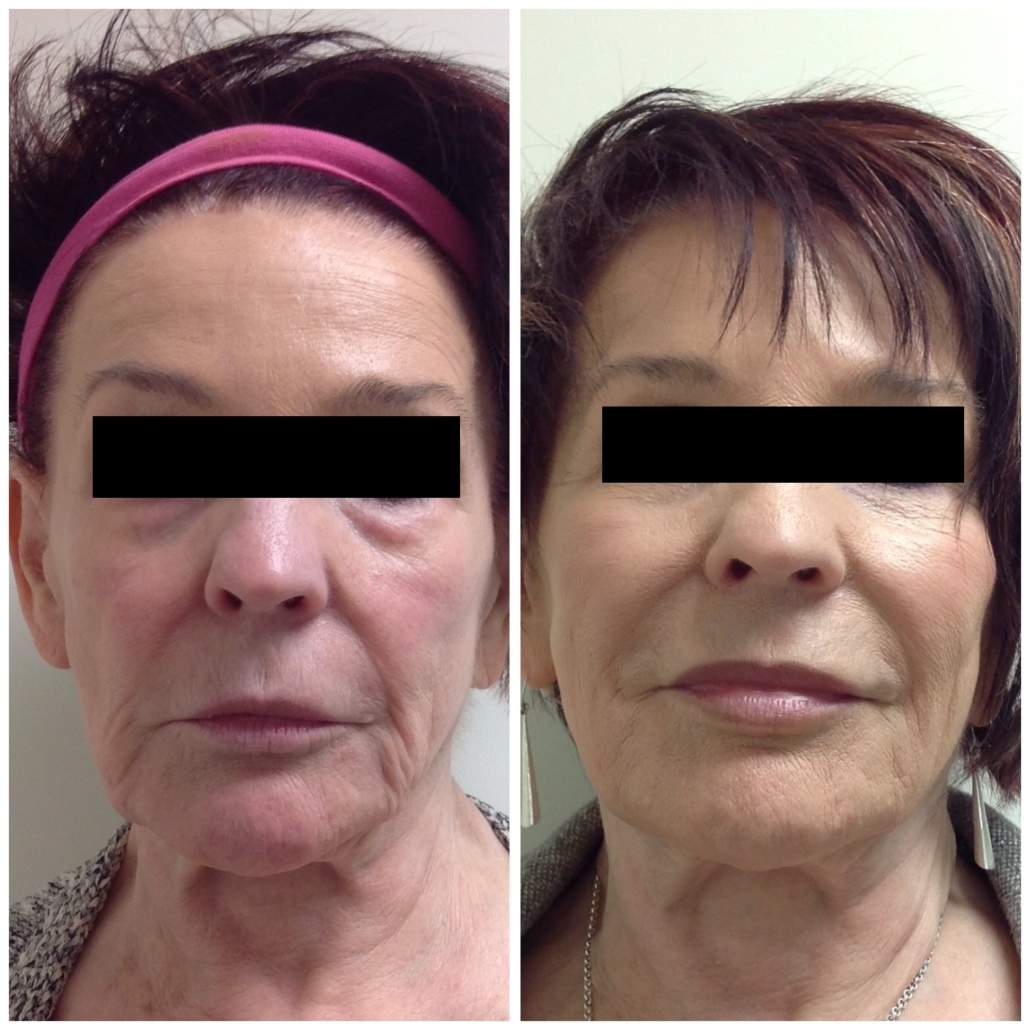 Full Face Before And After Renew You Medical Spa 3981